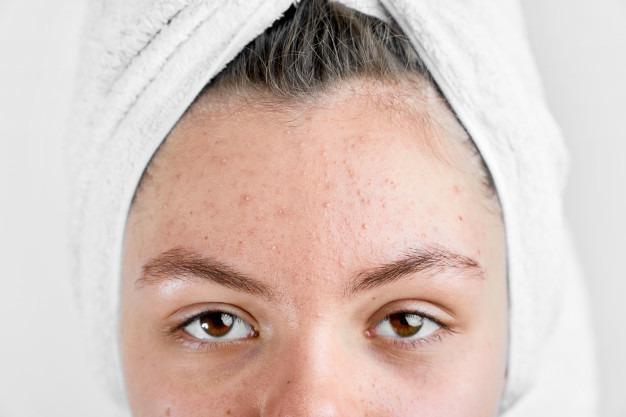 skin|acne treatment