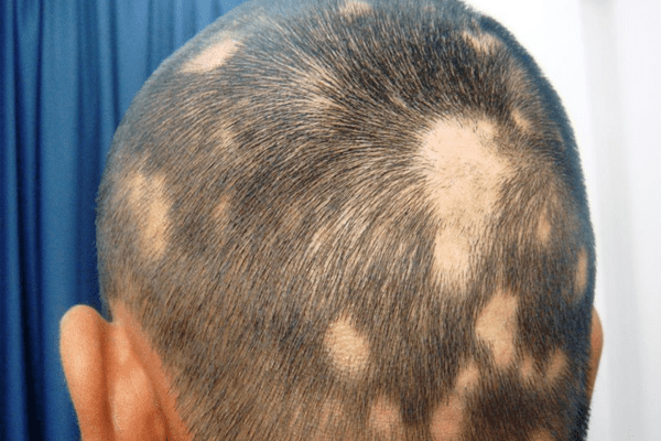 Alopecia_Areata