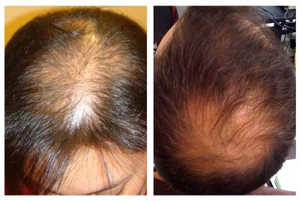 Male & Female Pattern Baldness (Androgenetic Alopecia)
