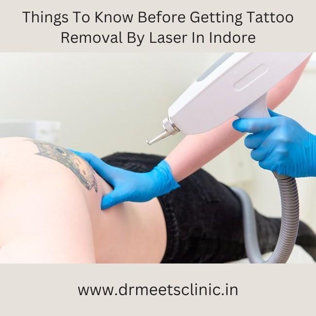 Tattoo Removal By Laser In Indore