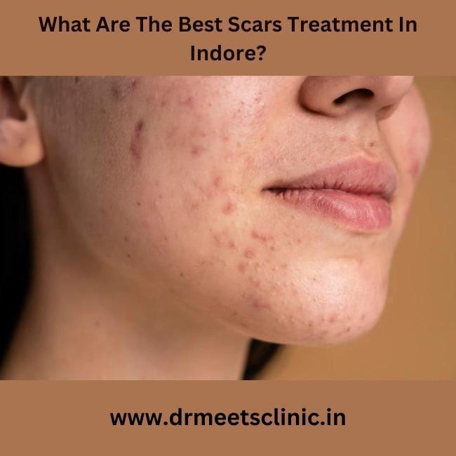 Best Scars Treatment In Indore