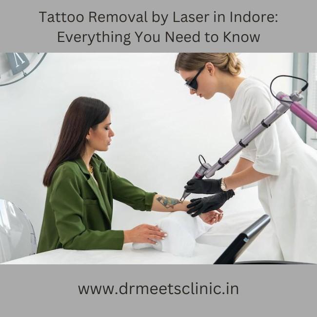 Tattoo Removal by Laser