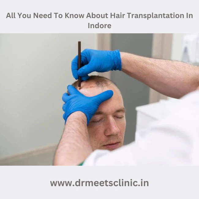 Hair Transplantation In Indore