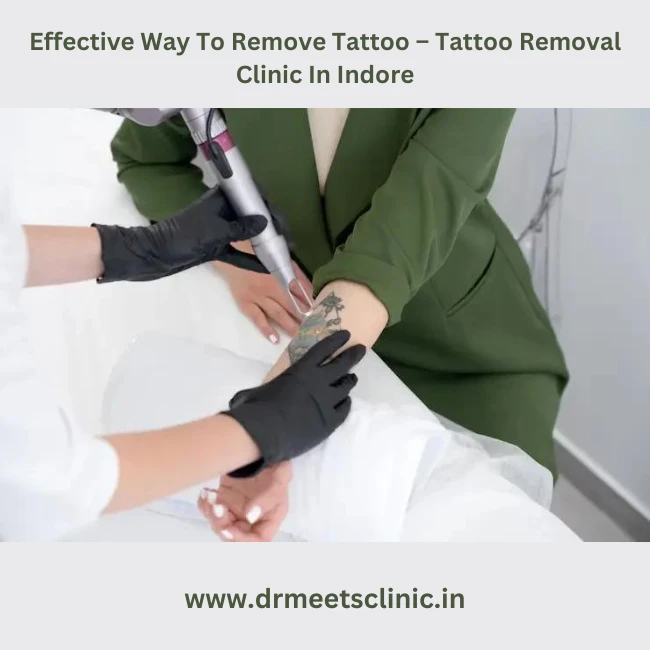 Tattoo Removal Clinic In Indore