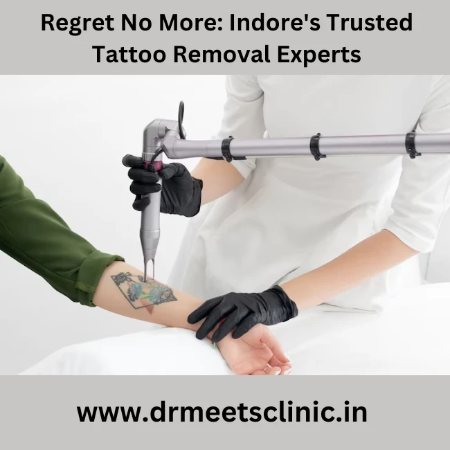 Best Tattoo removal treatment in Indore