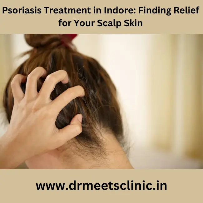 psoriasis treatment in Indore