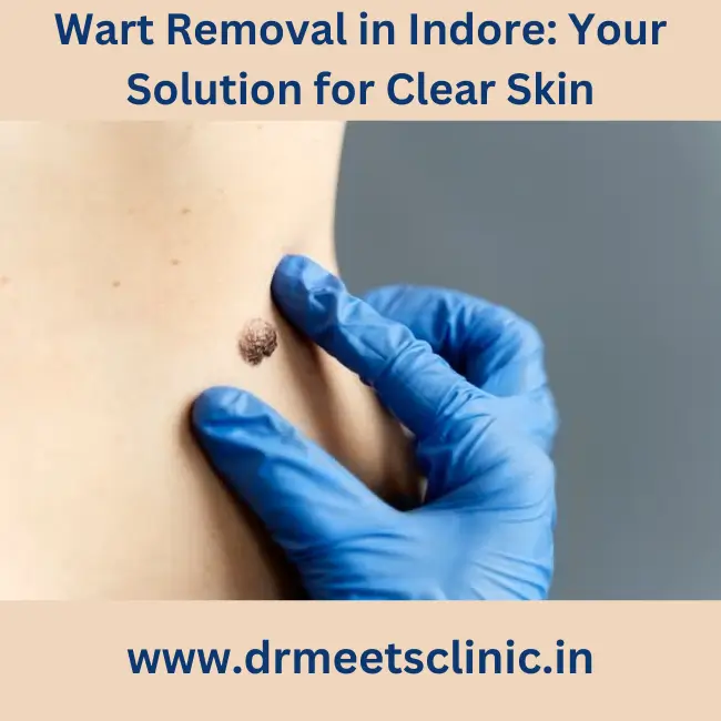 wart removal in Indore