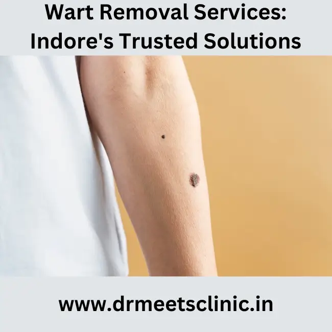 wart removal in Indore
